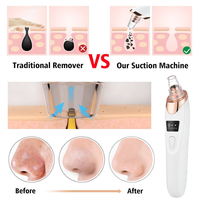 Vacuum Electric Blackhead Remover Cleaner Johnny O's Goods